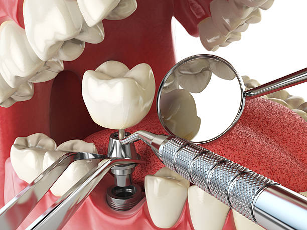 Best Emergency Tooth Extraction in Ash Grove, MO